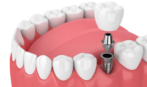 Dental Implants