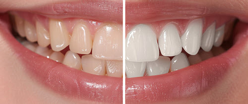 Whitening