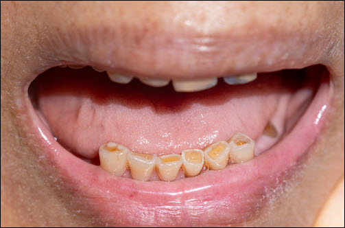 Bruxism