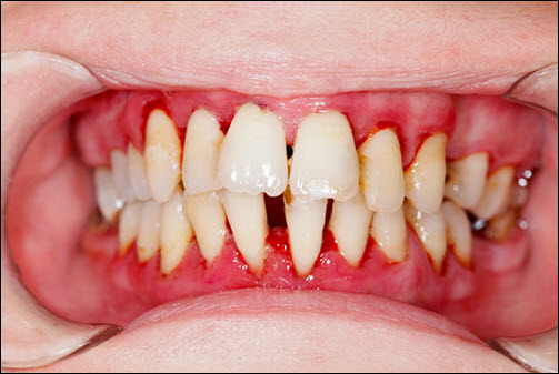 Gingivitis