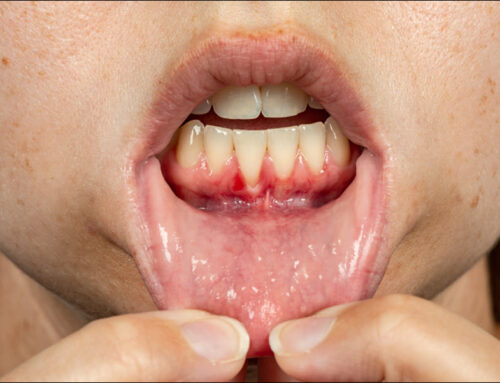 Preventing Gum Disease for a Healthier Smile