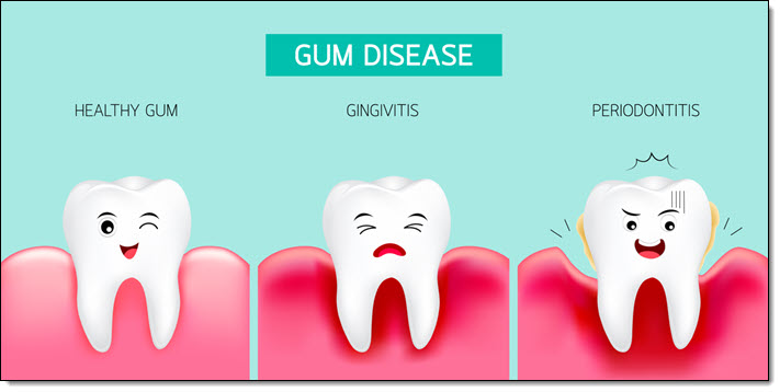 Heart Health and Gingivitis