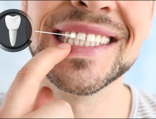 Dental Implants: A Solution for Missing Teeth