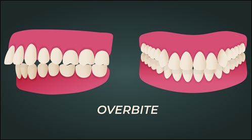 Overbite