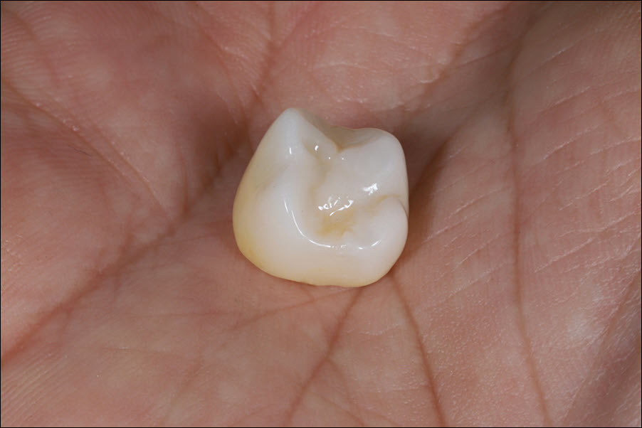 Dental Crown