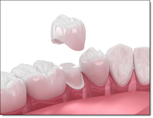 Dental Crown